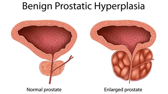 Image result for benign prostatic hyperplasia (bph)