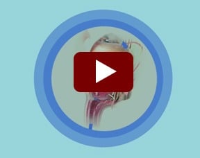 Robotic Prostate Surgery Video Still
