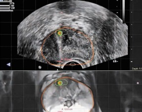 Ultrasound being performed on Prostate Cancer