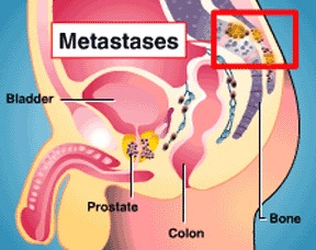 Metastatic Prostate Cancer Diagram2