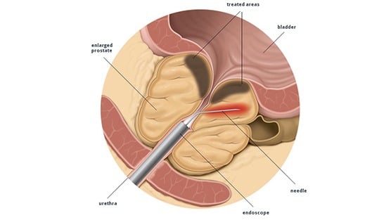 Transurethral needle ablation (TUNA) - Prostaffect сumpără