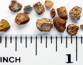 The Different Types Of Kidney Stones Thumbnail