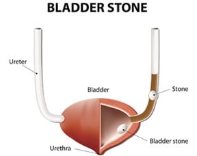 What Are Bladder Stones Thumbnail