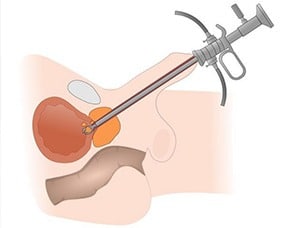 What Is A Transurethral Incision Of The Prostate (TUIP) Thumbnail