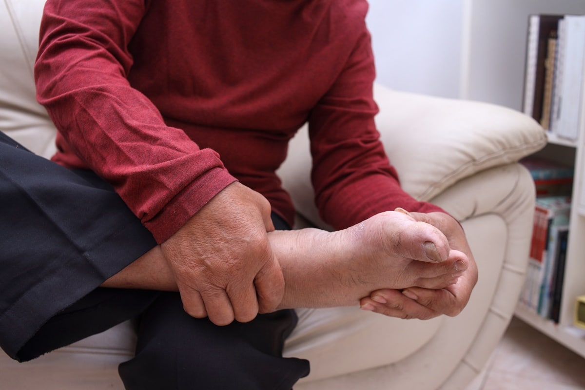 Gout increases risk of benign prostatic hyperplasia in younger men