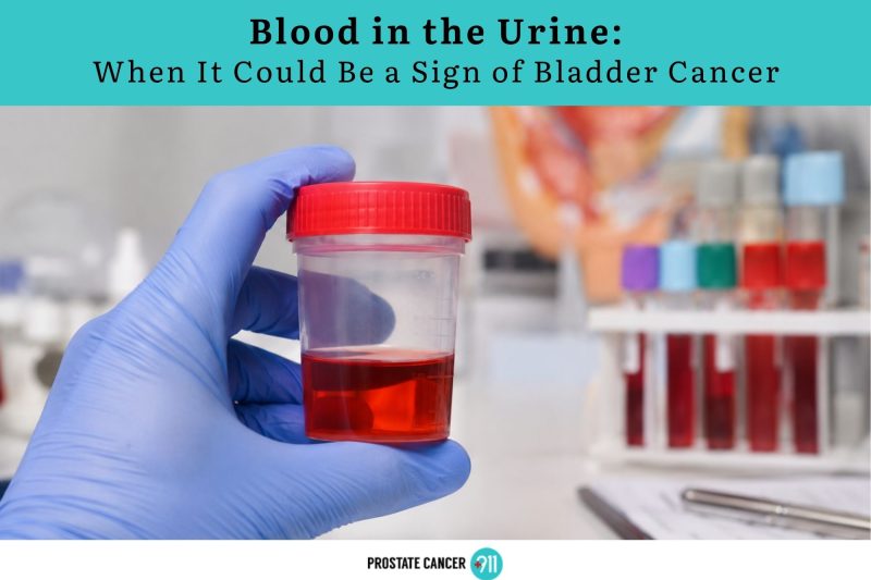Blood in the Urine: When It Could Be a Sign of Bladder Cancer